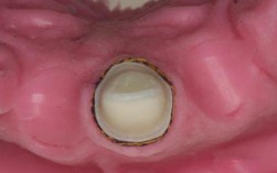 在口腔修复临床操作中，常用的排龈方法有哪些？不同方法的具体操作步骤、适应症及注意事项分别是什么？