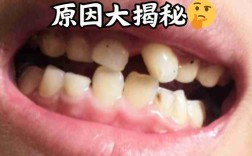 缺牙后牙齿倾斜，种牙前必须先处理倾斜问题吗？