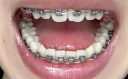 牙齿正畸过程中牙疼