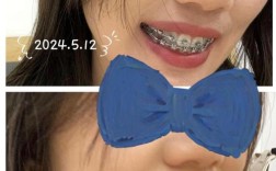 牙齿正畸 拔四颗牙