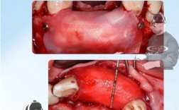 种牙为何要做游离植骨？效果和安全性如何？