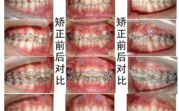 19岁矫正牙齿还正常吗？这个年龄做矫正合适吗？