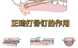 矫正牙齿为什么打钉