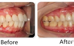 矫正牙齿失败，问题究竟出在哪？
