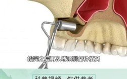 植牙外提升咳嗽