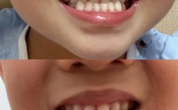 牙齿矫正地包天，最佳矫正时机是几岁？