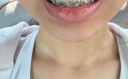 正畸牙齿第一天