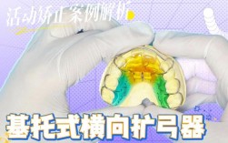 下颌正畸基托制作视频