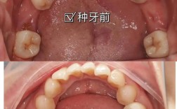 种植牙前后牙龈沟有何变化？术后如何护理牙龈沟？