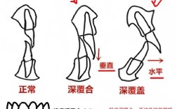 正畸深覆颌的分类