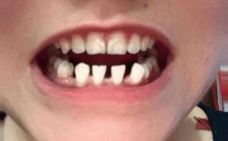 矫正牙齿牙齿稀疏