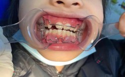 美国正畸协会为何强调儿童早期矫正的必要性？