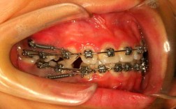 二次正畸必用种植钉吗？作用与风险解析