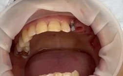种牙后带牙冠视频，牙冠安装过程是怎样的？