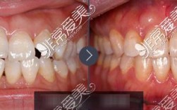 南京华美口腔正畸效果如何？真实体验值得选吗？