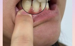 牙齿矫正期间牙龈萎缩