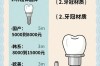 郑州种植牙哪里便宜？这几家报价亲民，靠谱吗？