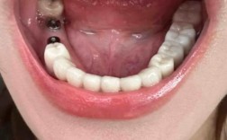 保定市二医院植牙效果如何？价格贵不贵？技术靠谱吗？