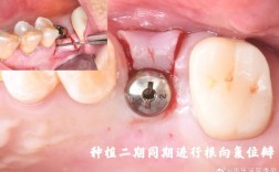 珠海公立医院植牙效果如何？价格贵不贵？靠谱吗？