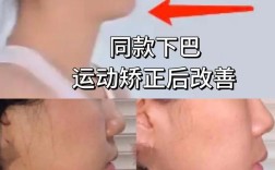 正颌后必须正畸吗