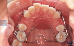 正畸种植支抗打开咬合的原理与效果如何？