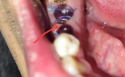 种植牙种牙根后怀孕