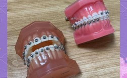 正畸咬模型多少钱
