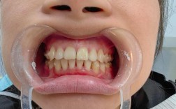 隐适美正畸牙齿没齐