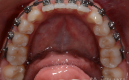 正畸钢丝滑动关闭间隙的操作步骤与技巧有哪些？