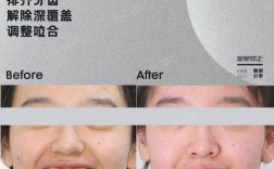 英国牙齿矫正多久