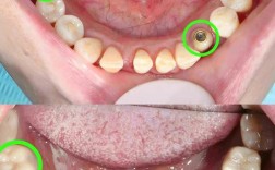 全部磨牙缺失 种牙