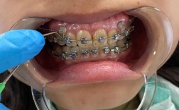 牙齿矫正戴牙套会痛吗？