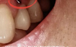 拔牙后为何等一年再种牙？最佳时机有讲究吗？