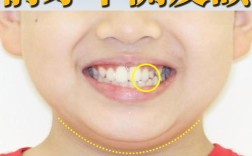 10岁孩子牙齿正畸