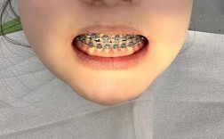 牙齿矫正后下巴歪了？是矫正问题还是正常反应？