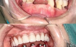 植骨种牙效果图