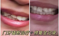 门牙磕掉后有哪些治疗方法？如何正确处理和修复？