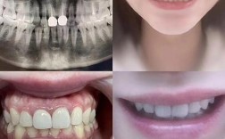 矫正后门牙为何留缝隙？是矫正失败还是正常现象？