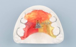 正畸用的工具牙套