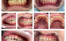 男生矫正牙齿前后差异能有多大？效果是否惊艳？