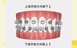 矫正牙齿中，托槽到底是什么？