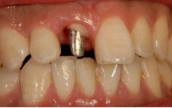 种牙的牙桩究竟是什么样子的？材质、形状、颜色如何？