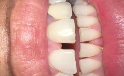 矫正牙齿后出现缝隙是正常现象吗？