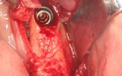 种植牙拔牙时植骨