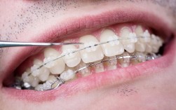 隐形矫正中牙齿松动正常吗？需警惕还是矫正常态？