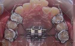 正畸刺激下颌骨生长