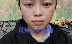 做牙齿矫正很痛苦吗