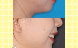 美容冠矫正和正畸有何区别？如何根据需求选择？