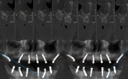 中山实时负重种植牙是什么技术？为何能当天负重使用效果如何？