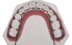 什么时候直弓丝正畸